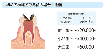 初めて神経を取る歯の場合