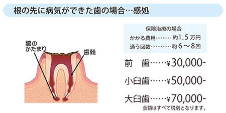 根の先に病気ができた歯の場合