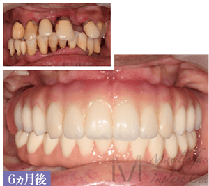beforeafter