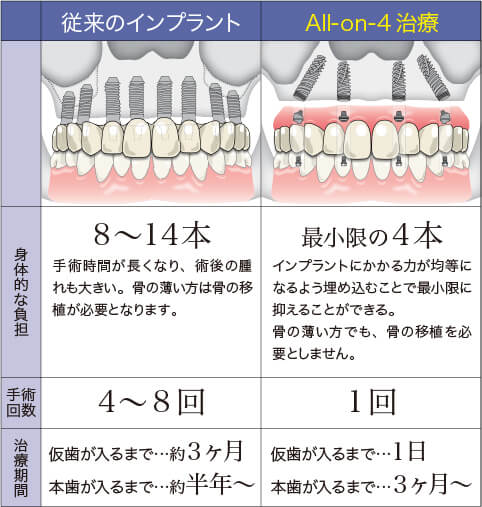 インプラント比較