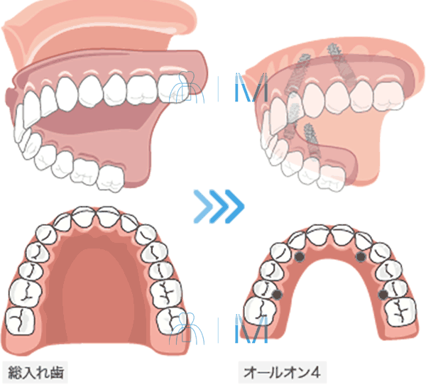 All-on-4 と 総義歯