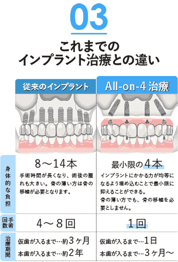 All-on-4と通常インプラントの違い