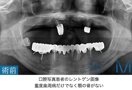 ザイゴマインプラント術前