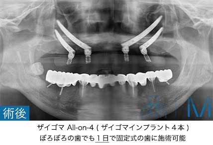ザイゴマインプラント術後