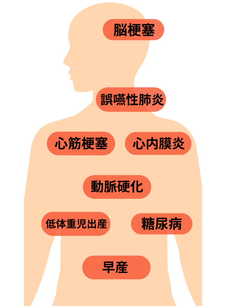 歯周病の影響。ナルト先生を中心に安心の歯科医療を提供。オールオン4ザイゴマクリニック。