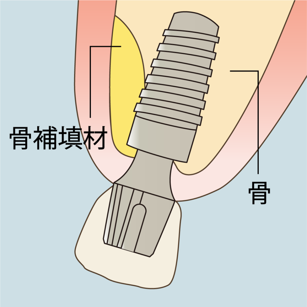 GBRのイラスト。ナルト先生を中心に安心の歯科医療を提供。オールオン4ザイゴマクリニック。