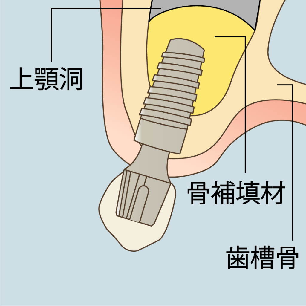 サイナスリフトのイラスト。ナルト先生を中心に安心の歯科医療を提供。オールオン4ザイゴマクリニック。