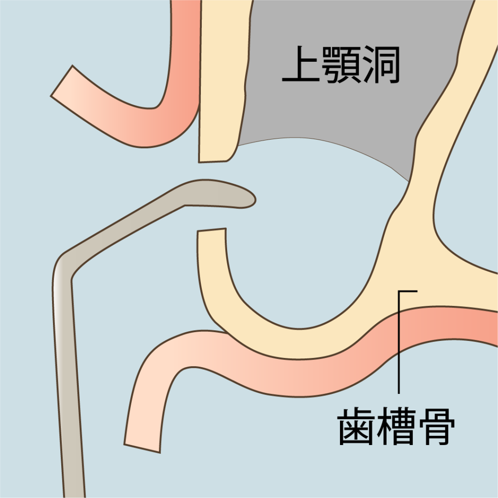サイナスリフト治療の流れ。ナルト先生を中心に安心の歯科医療を提供。オールオン4ザイゴマクリニック。