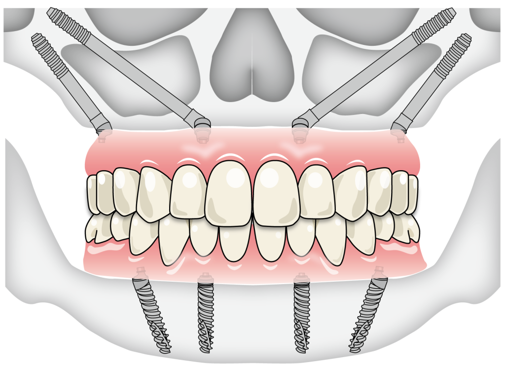 ナルト先生のオールオン4ザイゴマ。オールオン4ザイゴマクリニック。