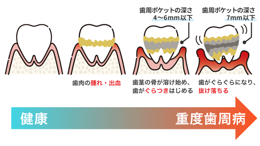 歯周病進行の流れ。ナルト先生を中心に安心の歯科医療を提供。オールオン4ザイゴマクリニック。